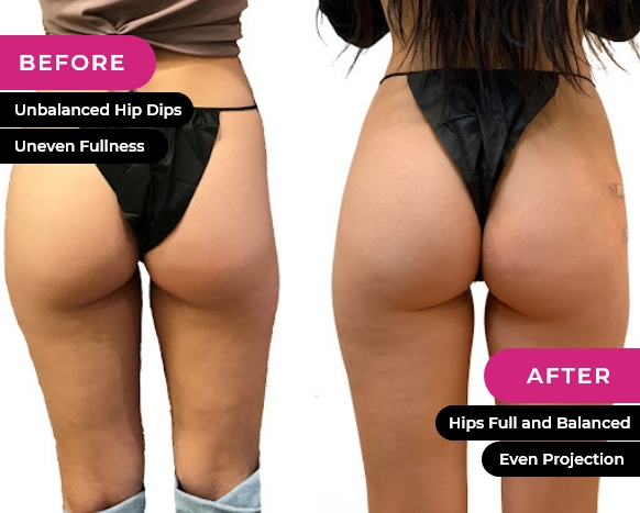 How many vials of sculptra would I need to fill out my hip dips? (photos)